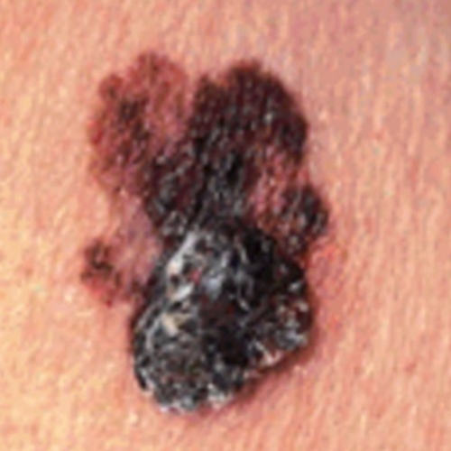 Saúde da pele: 10 questões sobre Melanoma